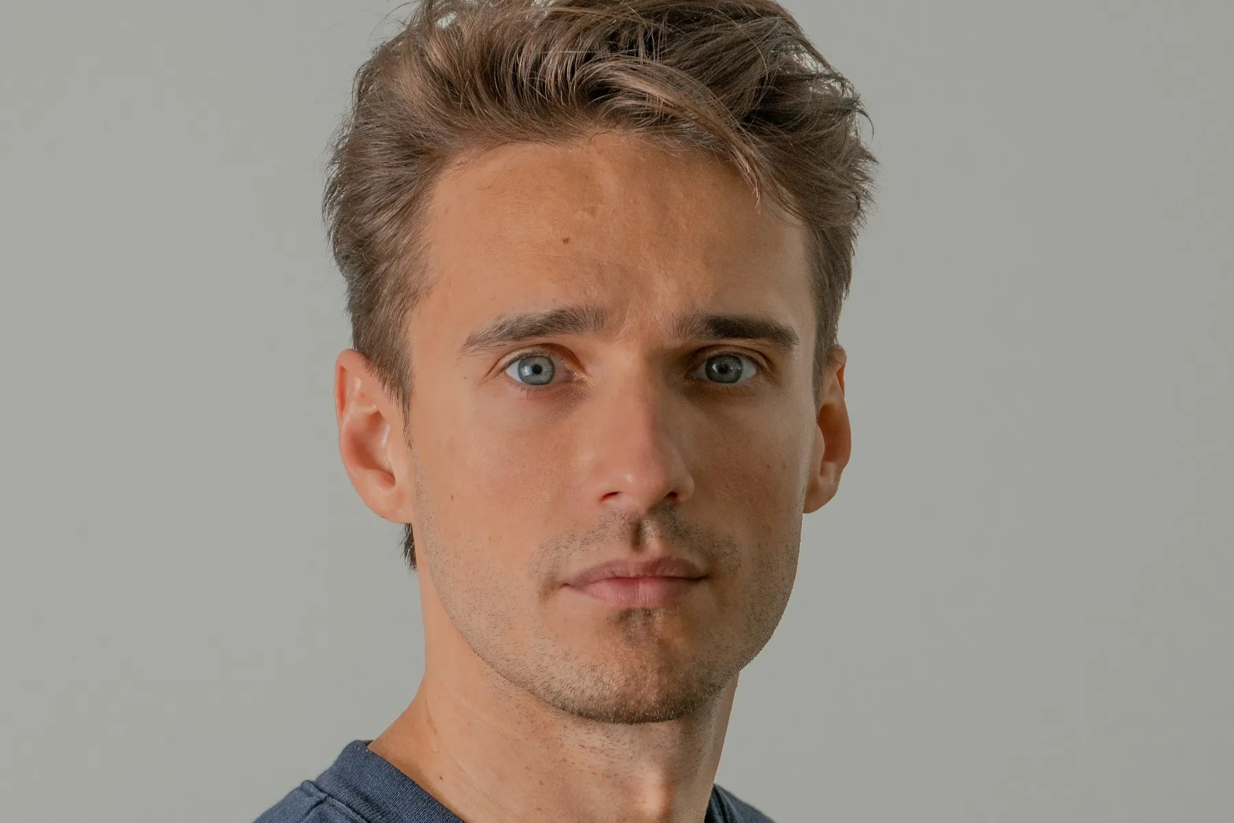 Cirugía de rinoplastia en fisura labiopalatina — Dr. Nico Sierra Barcelona