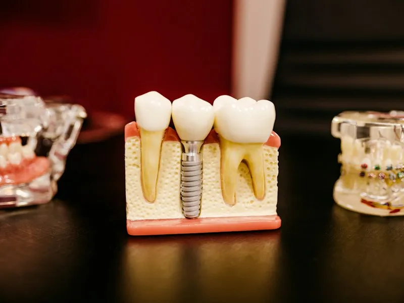 Modelo dental con implantes y estructura de encía junto a otros modelos de dientes