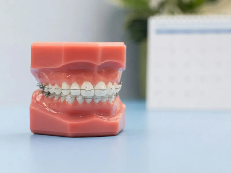 Modelo dental de arcadas con brackets metálicos sobre una mesa